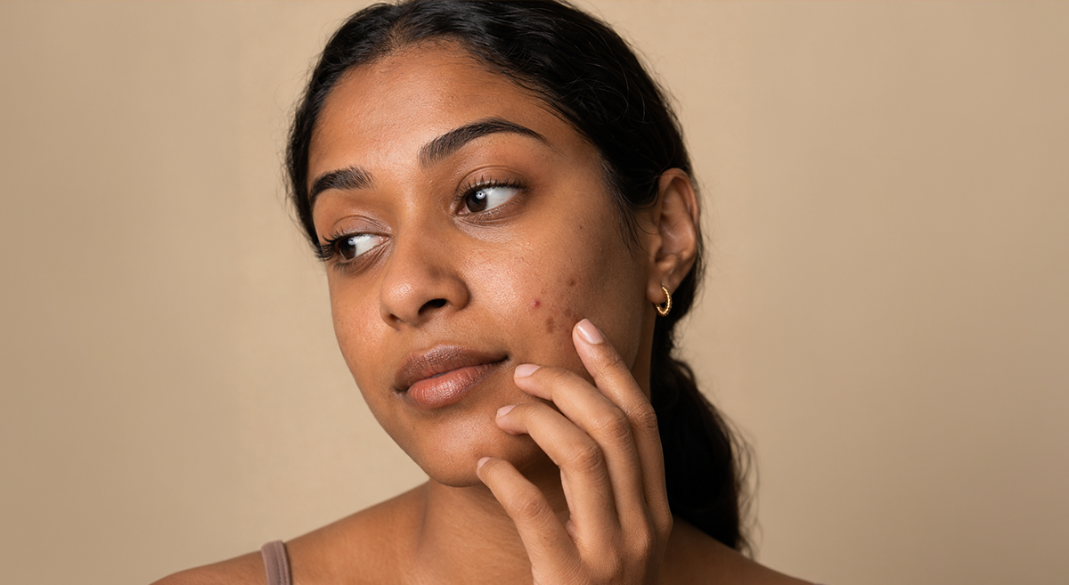 Close-up of a person with dark skin examining their cheek in natural light, with a small blemish and a fading post-acne mark visible